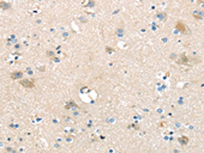 The image on the left is immunohistochemistry of paraffin-embedded Human brain tissue using SLC16A11 Antibody(SLC16A11 Antibody) at dilution 1/25, on the right is treated with synthetic peptide. (Original magnification: ×200)Rabbit anti-Human SLC16A11 Polyclonal Antibody