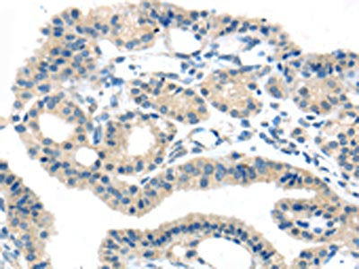 The image on the left is immunohistochemistry of paraffin-embedded Human thyroid cancer tissue using the antibody Antibody) at dilution 1/25, on the right is treated with synthetic peptide. (Original magnification: ×200)Rabbit anti-Human SLC16A11 Polyclonal Antibody