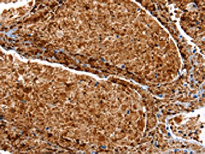 The image on the left is immunohistochemistry of paraffin-embedded Human lung cancer tissue using SERPINA3 Antibody(SERPINA3 Antibody) at dilution 1/12, on the right is treated with synthetic peptide. (Original magnification: ×200)Rabbit anti-Human SERPINA3 Polyclonal Antibody
