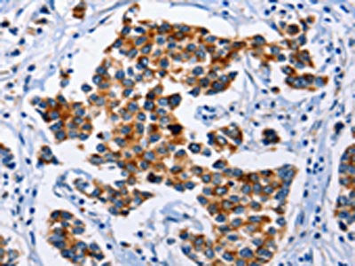 The image on the left is immunohistochemistry of paraffin-embedded Human breast cancer tissue using the antibody Antibody) at dilution 1/12, on the right is treated with synthetic peptide. (Original magnification: ×200)Rabbit anti-Human SERPINA3 Polyclonal Antibody