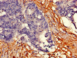 Immunohistochemistry of paraffin-embedded human colon cancer using TPH2 Antibody at dilution of 1:100Rabbit anti-Human TPH2 Polyclonal Antibody