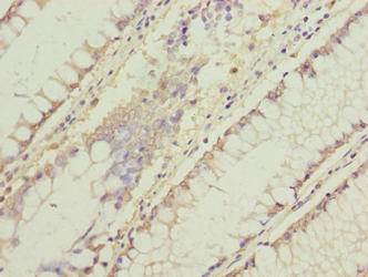 Immunohistochemistry of paraffin-embedded human colon cancer using C11orf53 Antibody at dilution of 1:100