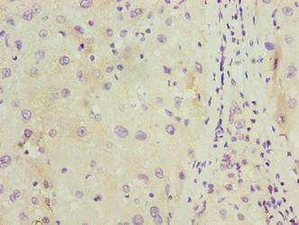 Immunohistochemistry of paraffin-embedded human liver cancer using C11orf53 Antibody at dilution of 1:100