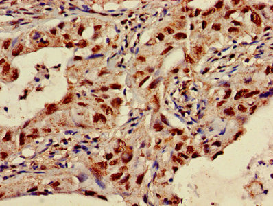Immunohistochemistry of paraffin-embedded human lung cancer using SLC35F2 Antibody at dilution of 1:100Rabbit anti-Human SLC35F2 Polyclonal Antibody