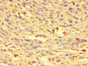 Immunohistochemistry of paraffin-embedded human melanoma using the antibody at dilution of 1:100Rabbit anti-Human CKAP2L Polyclonal Antibody
