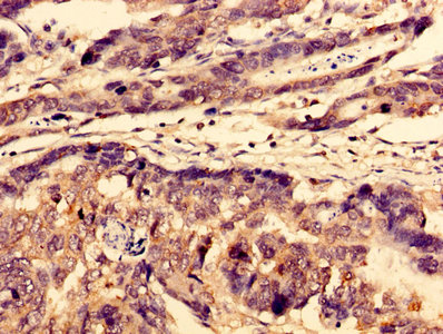 Immunohistochemistry of paraffin-embedded human gastric cancer using the antibody at dilution of 1:100Rabbit anti-Human WDFY3 Polyclonal Antibody