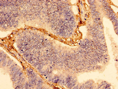 Immunohistochemistry of paraffin-embedded human colon cancer using WDFY3 Antibody at dilution of 1:100Rabbit anti-Human WDFY3 Polyclonal Antibody