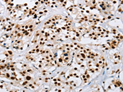 The image on the left is immunohistochemistry of paraffin-embedded Human thyroid cancer tissue using IL17C Antibody(IL17C Antibody) at dilution 1/50, on the right is treated with synthetic peptide. (Original magnification: ×200)Rabbit anti-Human IL17C Polyclonal Antibody