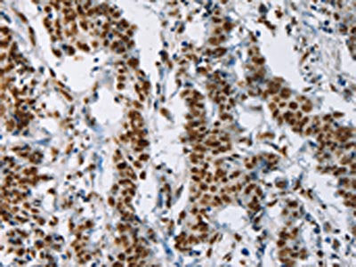 The image on the left is immunohistochemistry of paraffin-embedded Human gastic cancer tissue using the antibody Antibody) at dilution 1/50, on the right is treated with synthetic peptide. (Original magnification: ×200)Rabbit anti-Human IL17C Polyclonal Antibody