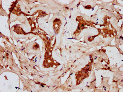IHC image of the antibody diluted at 1:300 and staining in paraffin-embedded human breast cancer performed on a Leica BondTM system. After dewaxing and hydration, antigen retrieval was mediated by high pressure in a citrate buffer (pH 6.0). Section was blocked with 10% normal goat serum 30min at RT. Then primary antibody (1% BSA) was incubated at 4°C overnight. The primary is detected by a biotinylated secondary antibody and visualized using an HRP conjugated SP system.Rabbit anti-Human CDAN1 Polyclonal Antibody