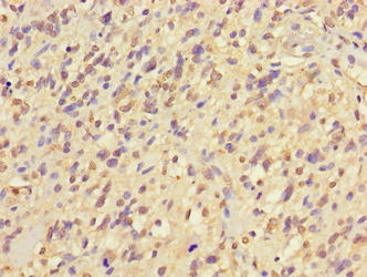 Immunohistochemistry of paraffin-embedded human glioma using NIM1K Antibody at dilution of 1:100Rabbit anti-Human NIM1K Polyclonal Antibody