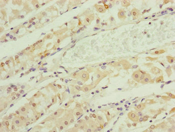 Immunohistochemistry of paraffin-embedded human gastric cancer using RNF135 Antibody at dilution of 1:100Rabbit anti-Human RNF135 Polyclonal Antibody
