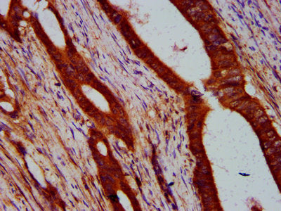 IHC image of ULK2 Antibody diluted at 1:400 and staining in paraffin-embedded human colon cancer performed on a Leica BondTM system. After dewaxing and hydration, antigen retrieval was mediated by high pressure in a citrate buffer (pH 6.0). Section was blocked with 10% normal goat serum 30min at RT. Then primary antibody (1% BSA) was incubated at 4°C overnight. The primary is detected by a biotinylated secondary antibody and visualized using an HRP conjugated SP system.Rabbit anti-Human ULK2 Polyclonal Antibody