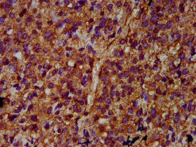 IHC image of ULK2 Antibody diluted at 1:400 and staining in paraffin-embedded human glioma performed on a Leica BondTM system. After dewaxing and hydration, antigen retrieval was mediated by high pressure in a citrate buffer (pH 6.0). Section was blocked with 10% normal goat serum 30min at RT. Then primary antibody (1% BSA) was incubated at 4°C overnight. The primary is detected by a biotinylated secondary antibody and visualized using an HRP conjugated SP system.Rabbit anti-Human ULK2 Polyclonal Antibody