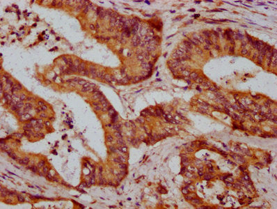 IHC image of ZDHHC14 Antibody diluted at 1:600 and staining in paraffin-embedded human colon cancer performed on a Leica BondTM system. After dewaxing and hydration, antigen retrieval was mediated by high pressure in a citrate buffer (pH 6.0). Section was blocked with 10% normal goat serum 30min at RT. Then primary antibody (1% BSA) was incubated at 4°C overnight. The primary is detected by a biotinylated secondary antibody and visualized using an HRP conjugated SP system.Rabbit anti-Human ZDHHC14 Polyclonal Antibody