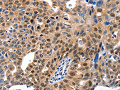The image on the left is immunohistochemistry of paraffin-embedded Human ovarian cancer tissue using the antibody Antibody) at dilution 1/15, on the right is treated with fusion protein. (Original magnification: ×200)