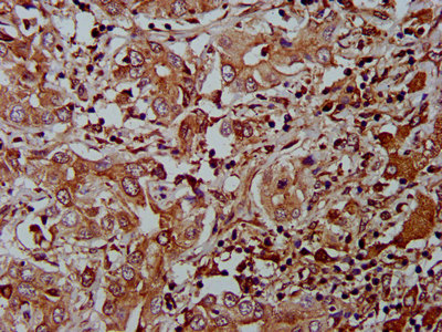 IHC image of the antibody diluted at 1:400 and staining in paraffin-embedded human liver cancer performed on a Leica BondTM system. After dewaxing and hydration, antigen retrieval was mediated by high pressure in a citrate buffer (pH 6.0). Section was blocked with 10% normal goat serum 30min at RT. Then primary antibody (1% BSA) was incubated at 4°C overnight. The primary is detected by a biotinylated secondary antibody and visualized using an HRP conjugated SP system.Rabbit anti-Human AHNAK2 Polyclonal Antibody