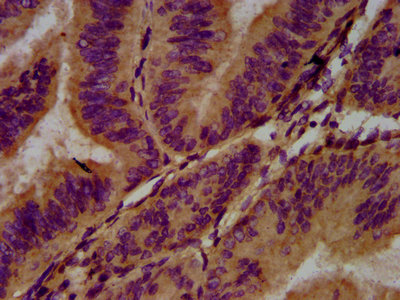 IHC image of the antibody diluted at 1:400 and staining in paraffin-embedded human endometrial cancer performed on a Leica BondTM system. After dewaxing and hydration, antigen retrieval was mediated by high pressure in a citrate buffer (pH 6.0). Section was blocked with 10% normal goat serum 30min at RT. Then primary antibody (1% BSA) was incubated at 4°C overnight. The primary is detected by a biotinylated secondary antibody and visualized using an HRP conjugated SP system.