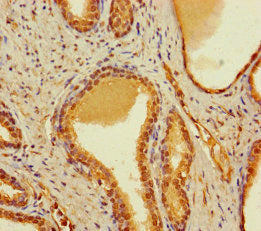 Immunohistochemistry of paraffin-embedded human prostate cancer using CBWD2 Antibody at dilution of 1:100