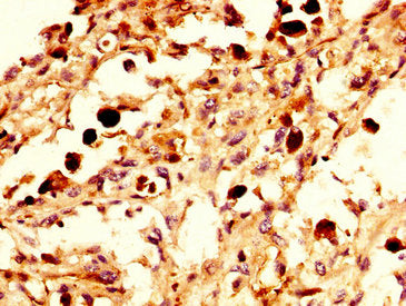 IHC image of NPAS4 Antibody diluted at 1:300 and staining in paraffin-embedded human melanoma performed on a Leica BondTM system. After dewaxing and hydration, antigen retrieval was mediated by high pressure in a citrate buffer (pH 6.0). Section was blocked with 10% normal goat serum 30min at RT. Then primary antibody (1% BSA) was incubated at 4°C overnight. The primary is detected by a biotinylated secondary antibody and visualized using an HRP conjugated SP system.Rabbit anti-Human NPAS4 Polyclonal Antibody