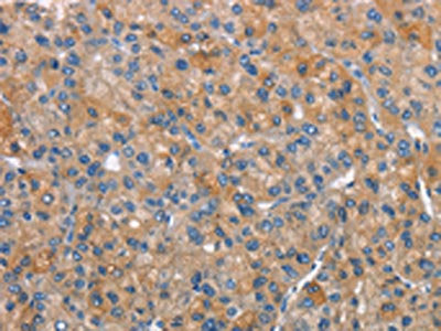 The image on the left is immunohistochemistry of paraffin-embedded Human liver cancer tissue using CEACAM1 Antibody(CEACAM1 Antibody) at dilution 1/25, on the right is treated with synthetic peptide. (Original magnification: ×200)Rabbit anti-Human CEACAM1 Polyclonal Antibody
