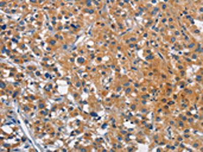 The image on the left is immunohistochemistry of paraffin-embedded Human thyroid cancer tissue using the antibody Antibody) at dilution 1/25, on the right is treated with synthetic peptide. (Original magnification: ×200)Rabbit anti-Human CEACAM1 Polyclonal Antibody