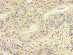 Immunohistochemistry of paraffin-embedded human colon cancer using the antibody at dilution of 1:100Rabbit anti-Human FMNL3 Polyclonal Antibody