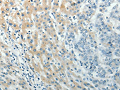 The image on the left is immunohistochemistry of paraffin-embedded Human liver cancer tissue using PXN Antibody(PXN Antibody) at dilution 1/40, on the right is treated with synthetic peptide. (Original magnification: ×200)Rabbit anti-Human PXN Polyclonal Antibody