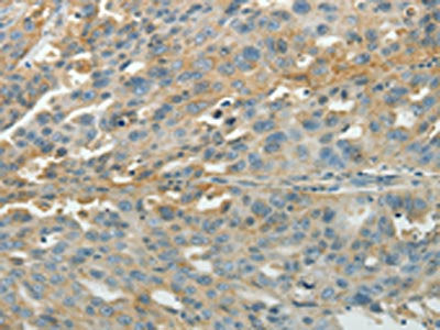 The image on the left is immunohistochemistry of paraffin-embedded Human ovarian cancer tissue using the antibody Antibody) at dilution 1/40, on the right is treated with synthetic peptide. (Original magnification: ×200)Rabbit anti-Human PXN Polyclonal Antibody
