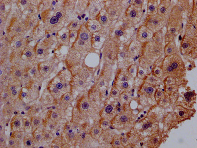 IHC image of IFNLR1 Antibody diluted at 1:200 and staining in paraffin-embedded human liver cancer performed on a Leica BondTM system. After dewaxing and hydration, antigen retrieval was mediated by high pressure in a citrate buffer (pH 6.0). Section was blocked with 10% normal goat serum 30min at RT. Then primary antibody (1% BSA) was incubated at 4°C overnight. The primary is detected by a Goat anti-rabbit polymer IgG labeled by HRP and visualized using 0.05% DAB.Rabbit anti-Human IFNLR1 Polyclonal Antibody
