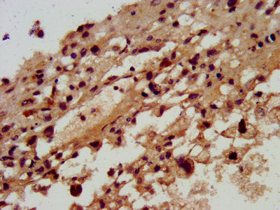 IHC image of SKA3 Antibody diluted at 1:300 and staining in paraffin-embedded human melanoma performed on a Leica BondTM system. After dewaxing and hydration, antigen retrieval was mediated by high pressure in a citrate buffer (pH 6.0). Section was blocked with 10% normal goat serum 30min at RT. Then primary antibody (1% BSA) was incubated at 4°C overnight. The primary is detected by a biotinylated secondary antibody and visualized using an HRP conjugated SP system.Rabbit anti-Human SKA3 Polyclonal Antibody