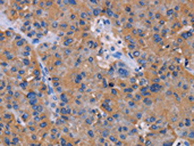The image on the left is immunohistochemistry of paraffin-embedded Human liver cancer tissue using the antibody Antibody) at dilution 1/30, on the right is treated with fusion protein. (Original magnification: ×200)Rabbit anti-Human NIT1 Polyclonal Antibody