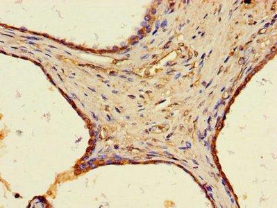 Immunohistochemistry of paraffin-embedded human prostate cancer using the antibody at dilution of 1:100Rabbit anti-Human WFDC8 Polyclonal Antibody