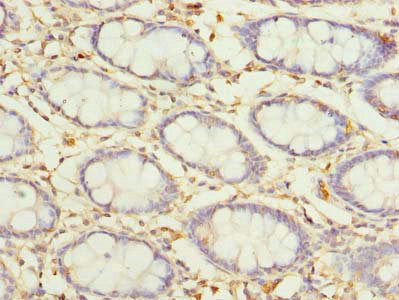 Immunohistochemistry of paraffin-embedded human colon tissue using COLGALT2 Antibody at dilution of 1:100Rabbit anti-Human COLGALT2 Polyclonal Antibody