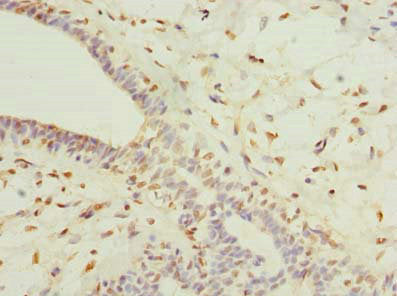 Immunohistochemistry of paraffin-embedded human breast cancer using COLGALT2 Antibody at dilution of 1:100Rabbit anti-Human COLGALT2 Polyclonal Antibody