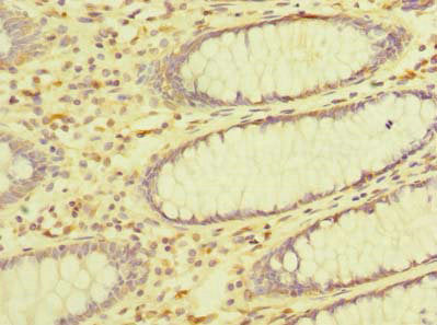 Immunohistochemistry of paraffin-embedded human colon cancer using ZDHHC23 Antibody at dilution of 1:100Rabbit anti-Human ZDHHC23 Polyclonal Antibody