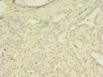 Immunohistochemistry of paraffin-embedded human breast cancer using the antibody at dilution of 1:100