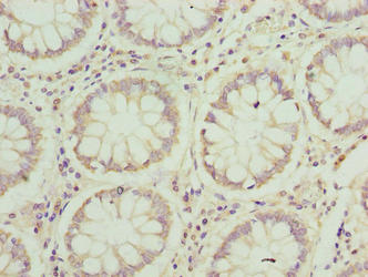 Immunohistochemistry of paraffin-embedded human colon cancer using JAGN1 Antibody at dilution of 1:100
