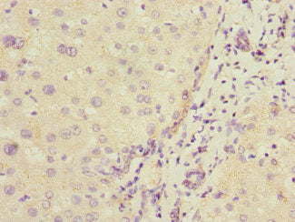 Immunohistochemistry of paraffin-embedded human liver cancer using COMMD1 Antibody at dilution of 1:100Rabbit anti-Human COMMD1 Polyclonal Antibody