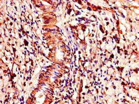 Immunohistochemistry of paraffin-embedded human gastric cancer using COMMD1 Antibody at dilution of 1:100Rabbit anti-Human COMMD1 Polyclonal Antibody