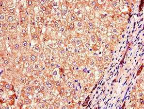 Immunohistochemistry of paraffin-embedded human liver cancer using COMMD1 Antibody at dilution of 1:100Rabbit anti-Human COMMD1 Polyclonal Antibody