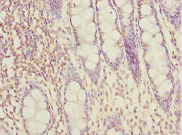 Immunohistochemistry of paraffin-embedded human colon tissue using SUPT20H Antibody at dilution of 1:100Rabbit anti-Human SUPT20H Polyclonal Antibody