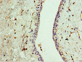 Immunohistochemistry of paraffin-embedded human breast cancer using GPRC5A Antibody at dilution of 1:100Rabbit anti-Human GPRC5A Polyclonal Antibody