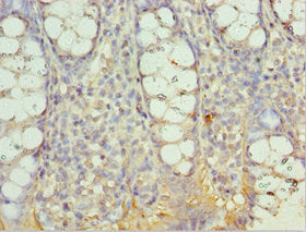 Immunohistochemistry of paraffin-embedded human colon cancer using AIMP2 Antibody at dilution of 1:100Rabbit anti-Human AIMP2 Polyclonal Antibody