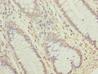 Immunohistochemistry of paraffin-embedded human colon cancer using NUBPL Antibody at dilution of 1:100Rabbit anti-Human NUBPL Polyclonal Antibody