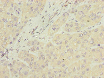 Immunohistochemistry of paraffin-embedded human liver cancer using NUBPL Antibody at dilution of 1:100Rabbit anti-Human NUBPL Polyclonal Antibody