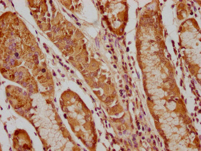 IHC image of PIP4K2C Antibody diluted at 1:200 and staining in paraffin-embedded human gastric cancer performed on a Leica BondTM system. After dewaxing and hydration, antigen retrieval was mediated by high pressure in a citrate buffer (pH 6.0). Section was blocked with 10% normal goat serum 30min at RT. Then primary antibody (1% BSA) was incubated at 4°C overnight. The primary is detected by a biotinylated secondary antibody and visualized using an HRP conjugated SP system.Rabbit anti-Human PIP4K2C Polyclonal Antibody