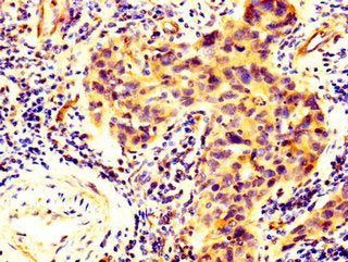 IHC image of GPBAR1 Antibody diluted at 1:300 and staining in paraffin-embedded human bladder cancer performed on a Leica BondTM system. After dewaxing and hydration, antigen retrieval was mediated by high pressure in a citrate buffer (pH 6.0). Section was blocked with 10% normal goat serum 30min at RT. Then primary antibody (1% BSA) was incubated at 4°C overnight. The primary is detected by a biotinylated secondary antibody and visualized using an HRP conjugated SP system.Rabbit anti-Human GPBAR1 Polyclonal Antibody