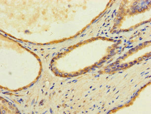 Immunohistochemistry of paraffin-embedded human prostate cancer using TMEM255B Antibody at dilution of 1:100Rabbit anti-Human TMEM255B Polyclonal Antibody
