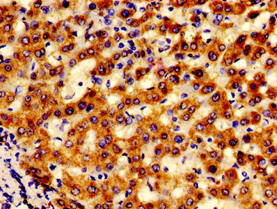 IHC image of AFG1L Antibody diluted at 1:600 and staining in paraffin-embedded human liver cancer performed on a Leica BondTM system. After dewaxing and hydration, antigen retrieval was mediated by high pressure in a citrate buffer (pH 6.0). Section was blocked with 10% normal goat serum 30min at RT. Then primary antibody (1% BSA) was incubated at 4°C overnight. The primary is detected by a biotinylated secondary antibody and visualized using an HRP conjugated SP system.Rabbit anti-Human AFG1L Polyclonal Antibody